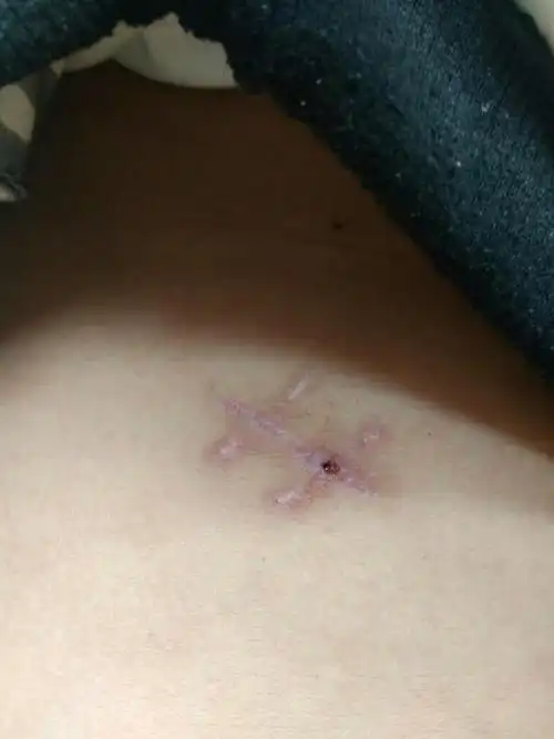 阑尾手术20天后,伤口抻了一下,流了一点血,有事吗?