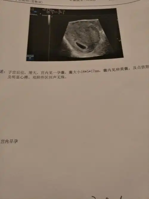 年年有余!怀孕45天孕囊大小"骨肉之情"-第2张图片-燕郊博客