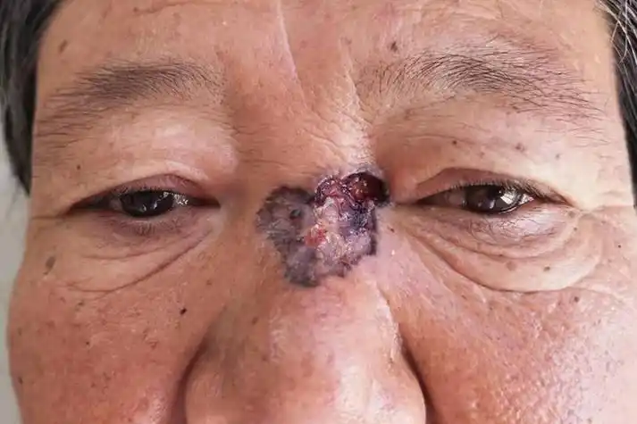皮肤癌的症状与表现图片_有来医生