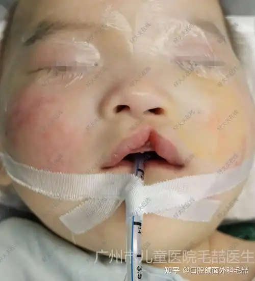 一度唇裂修复案例 - 知乎