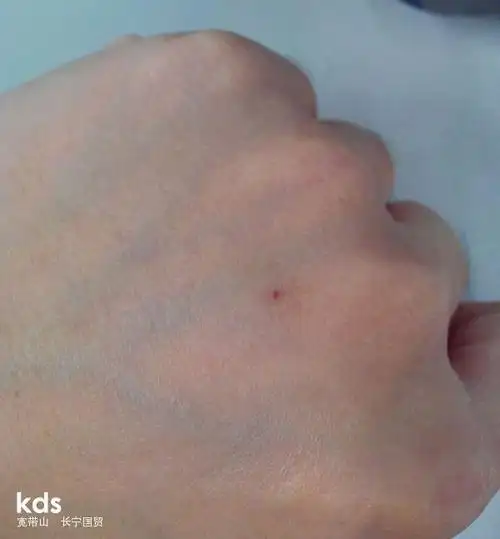 高人看过来,双手手背都有红痣,要紧伐?