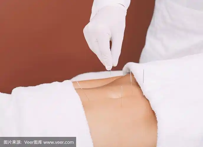 针刺妇女的腹部以消除腹痛.针灸针的特写