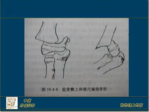 肱骨髁上骨折 (恢复)ppt_word文档在线阅读与下载_无忧文档