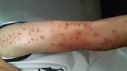 加拿大床虱大爆发!多伦多及士嘉堡虫最多!