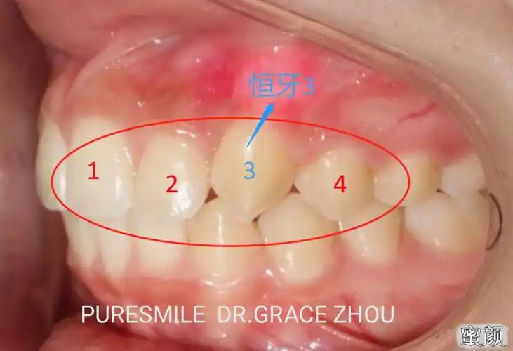 虎牙烦恼知多少?