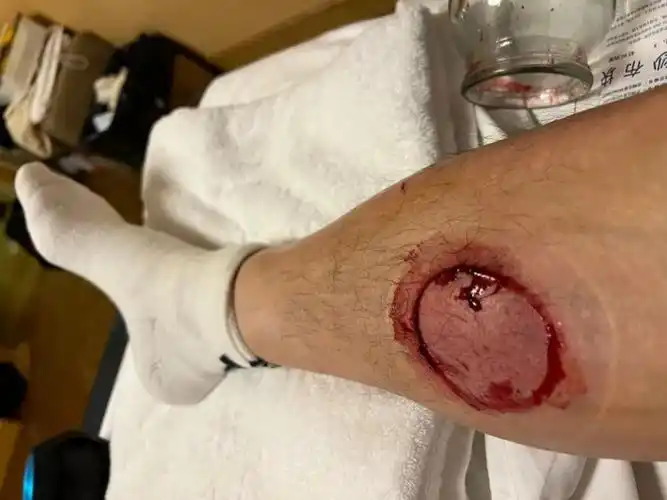 "今年季后赛第二阶段,刘晓宇在与广厦队第一次交锋时他的腿部肌肉拉伤