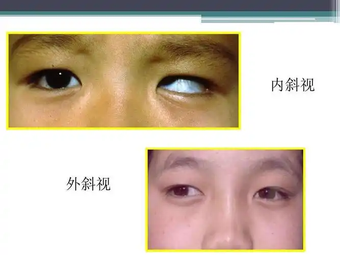 两者有什么不同我做过的典型的斜视病例图片儿童内斜视的屈光矫正慧妹