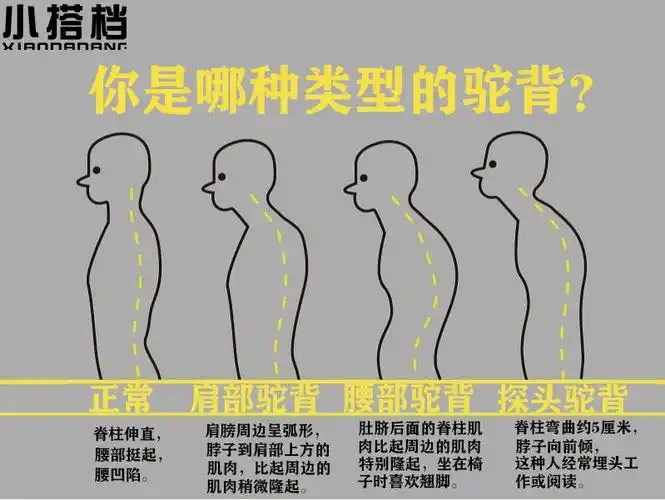 我们大多数驼背其实是"姿势性驼背"以及"习惯性驼背",远远达不到需要