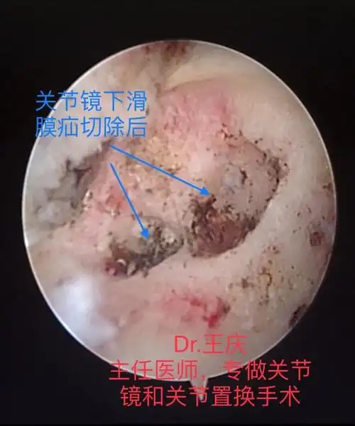 关节镜下滑膜疝切除后.jpg