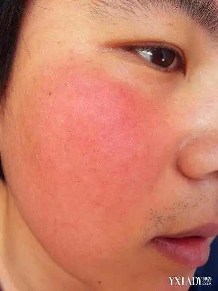 小常识脸发红发热怎么解决好 5步助你轻松解决问题