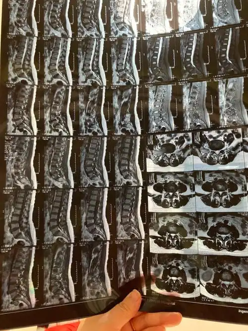 腰椎间盘突出腰疼