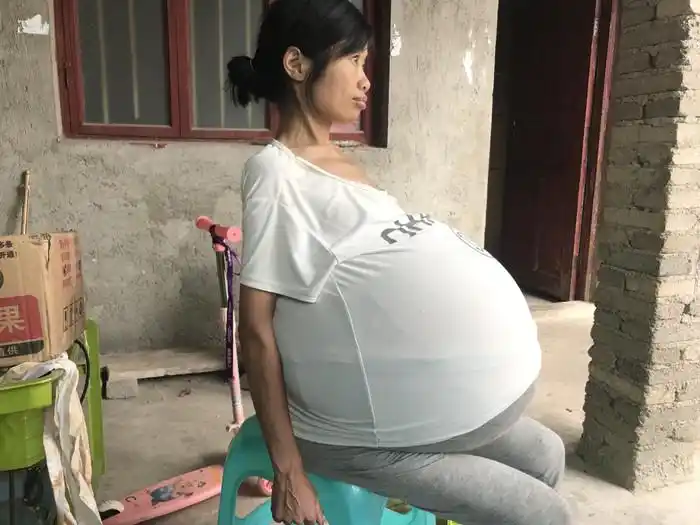 安顺一女子2年时间肚子长得比怀胎十月还大!这到底是什么病? - 当代先