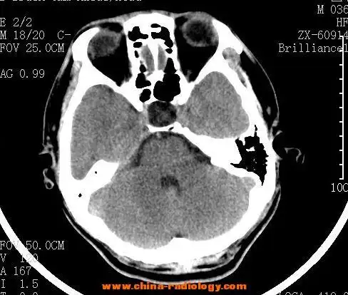 ct病例>>dongguangzuo001v.