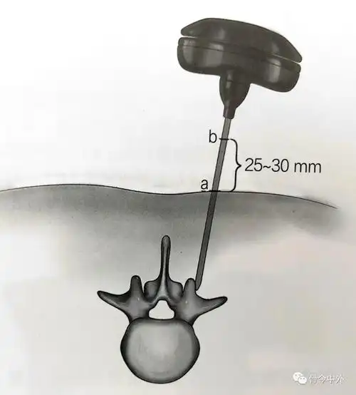 手把手教你精准置入经皮椎弓根螺钉!