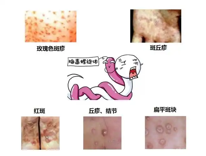 2.梅毒疹的皮肤表现是什么?