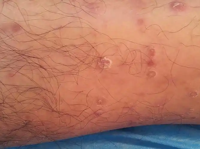 得了梅毒能怀孕要孩子吗