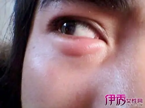 【图】下眼睑肿痛怎么回事呢 教你怎样预防眼皮肿