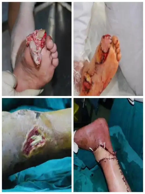 奋进中的手足外科