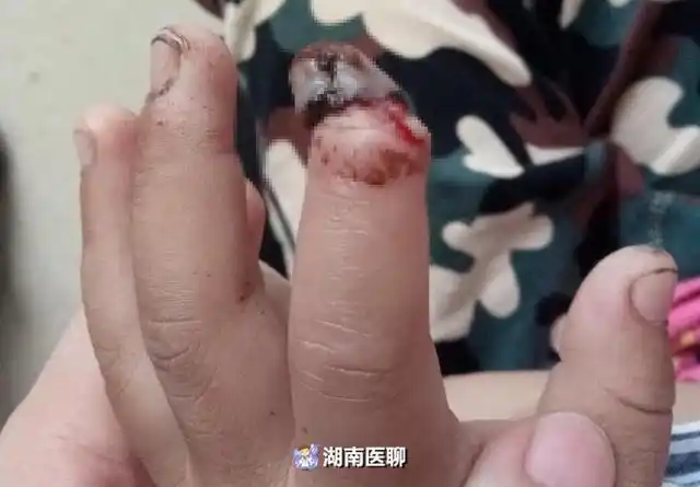 湖南5岁男童手指被切断4天后去医院指尖已坏死