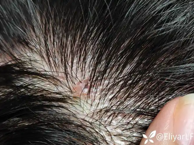 求助头皮疣状物物