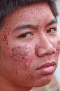 男性痘痘男性 ace 与痤疮问题皮肤照片