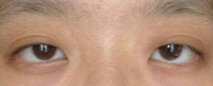 瞳孔靠上,瞳孔下方和左右眼白较多,如果再进行下睑下至,更显眼睛无神