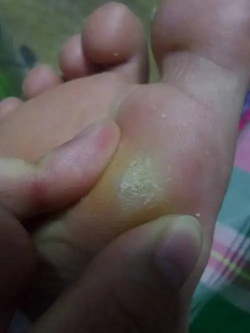 脚底长了个鸡眼(医院说的),修脚那说是肉刺,我自己拿刀弄了弄,里面