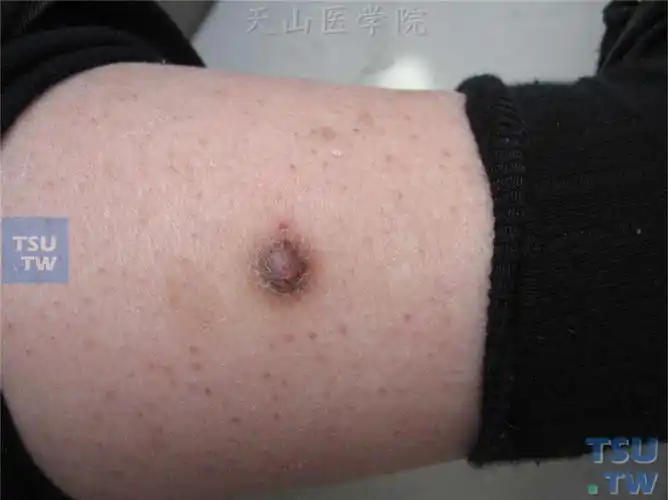 良性肿瘤皮肤纤维瘤dermatofibroma症状表现