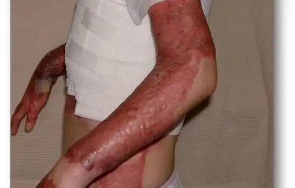 烧伤病人的体温调节