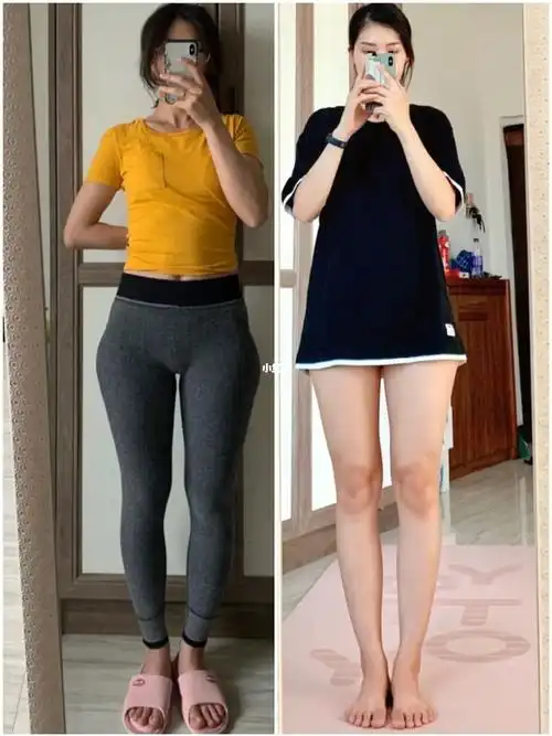 足弓无力,扁平足,足弓歪斜,走路就会有小腿肌肉代偿,拉动大腿股骨内旋