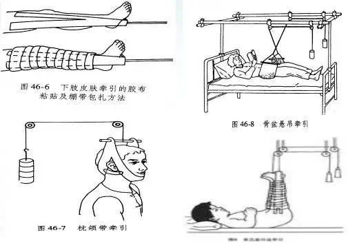骨科牵引的常用方式及要点,你都掌握了吗?
