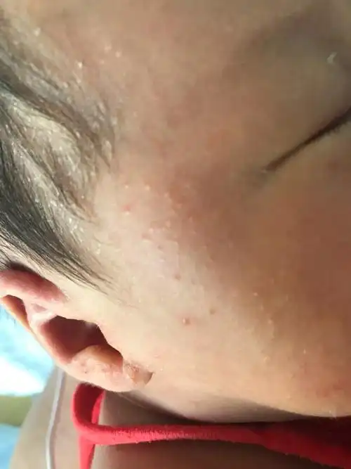 痱子是由于在高温闷热环境下,出汗过多,汗液蒸发不畅,导致汗管堵塞