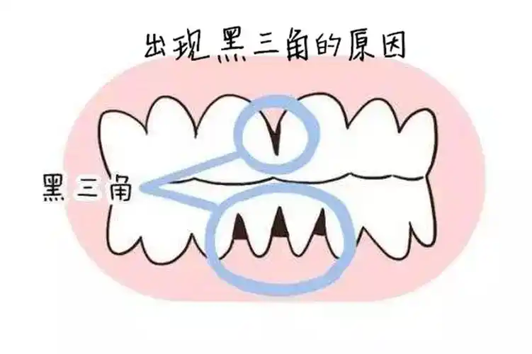 出现黑三角的原因是什么如何预防黑三角