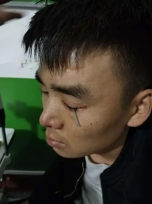 角膜穿透伤的救治