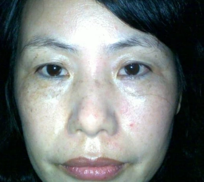 脸上肝斑图片42