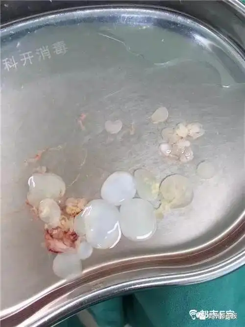 女子乳房竟发现虫子!原来她曾经这么做过.