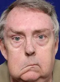 面瘫能彻底治好吗怎么治好得快