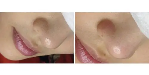 超微小气泡前后对比图超微小气泡效果图超微小气泡前后对比照片