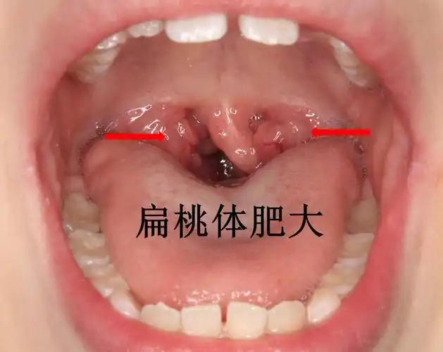 小孩有张口呼吸家长得警惕