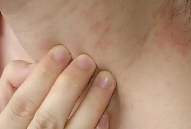 女性得艾滋病的初期症状图片_艾滋病的初期症状图_艾滋病初期