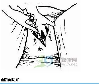 揭开"侧切"的神秘面纱