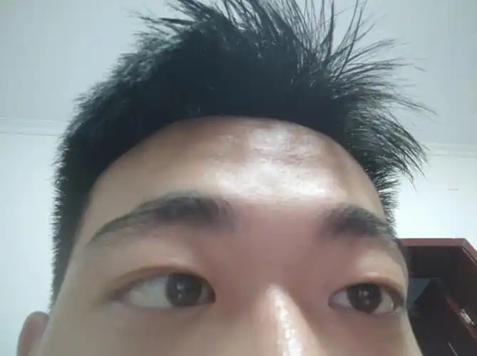 晶体植入近视眼手术