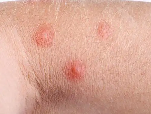 男士也会感染hpv身上出现1提示早检查别不好意思