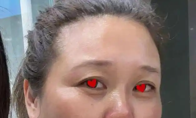 像咕咕她每次静态鱼尾纹一出来就会捡起15肉毒 微针大炮打蚊子,使劲打