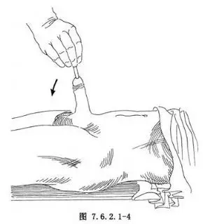 【尿道狭窄扩张术】尿道狭窄扩张术手术详细步骤,尿道狭窄扩张术手术