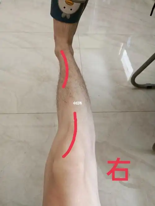 o型腿难道是小腿骨头就是弯的吗