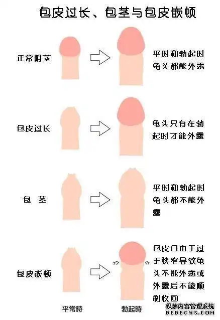 包皮过长的图片 包茎和包皮过长判断标准