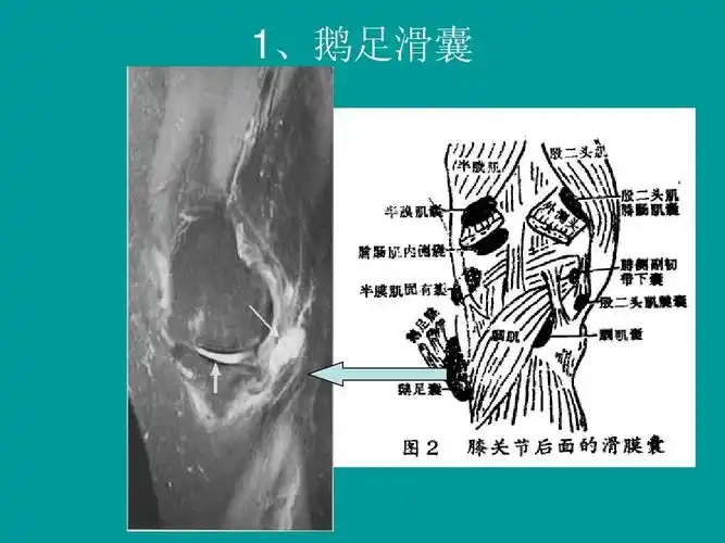 膝关节周围的滑膜囊