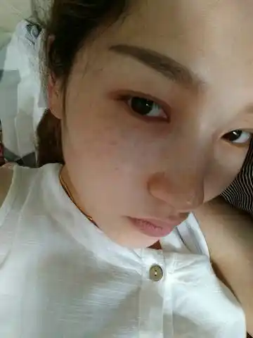 是晒斑还是妊娠斑还是黄鹤斑?能去掉么?