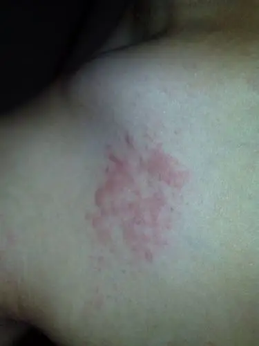 锁骨下方起了一大片红疙瘩 特别痒 有蔓延的趋势 请问这是什么